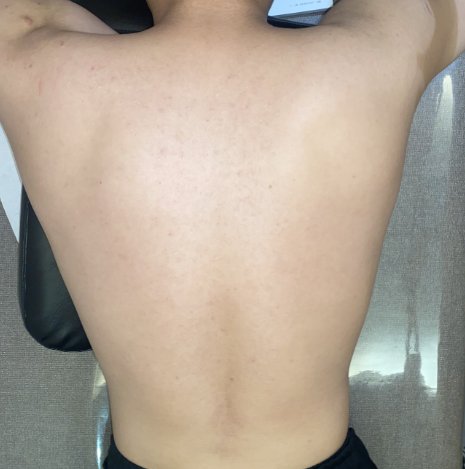 등 여드름 치료 후