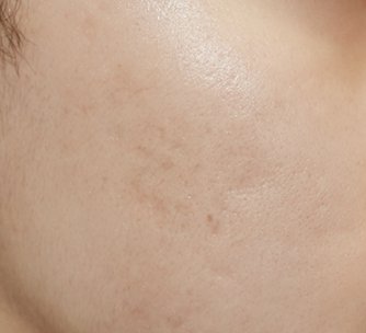 여드름 흉터 치료 후 볼 부위