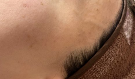 눈썹 주변 편평사마귀 치료 후